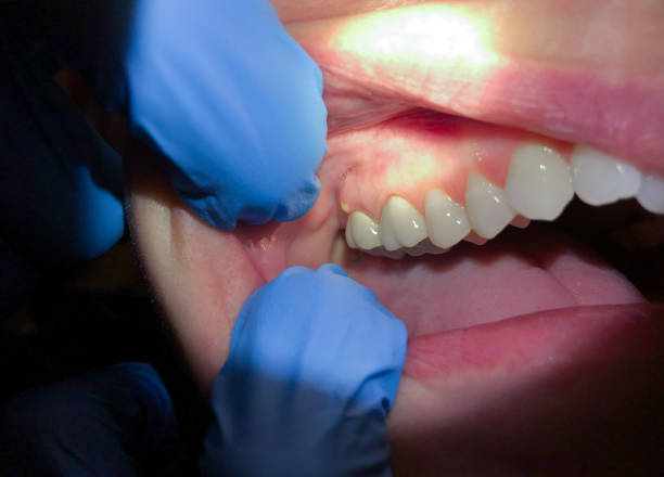 Best Emergency Tooth Extraction  in Grenada, MS